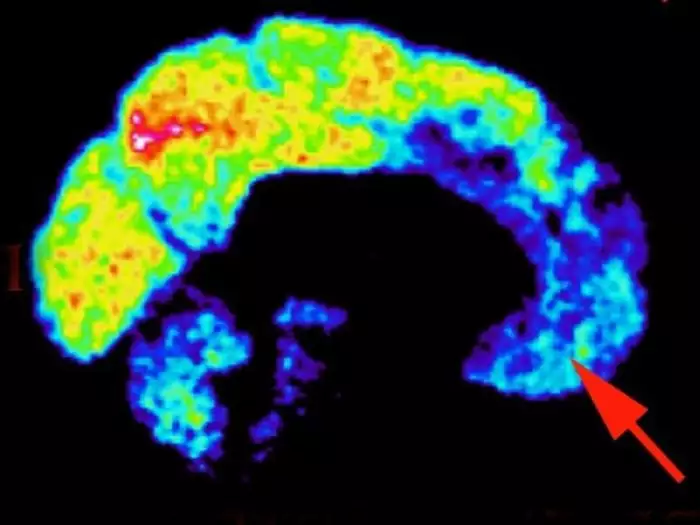 heres-what-a-psychopaths-brain-looks-like