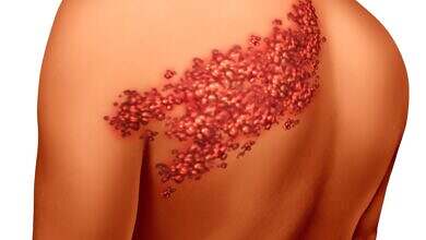 الحزام-الناري