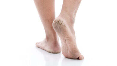 تشقق القدمين