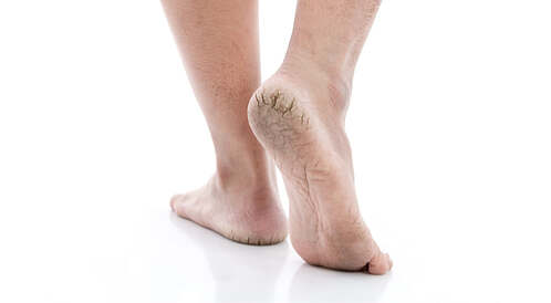 تشقق القدمين