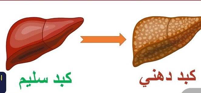 كبد دهني - سليم