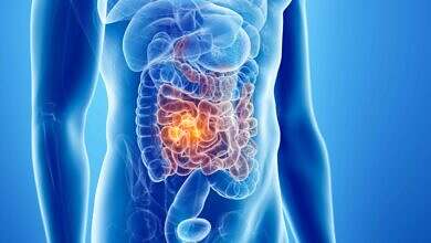 سرطان الامعاء0