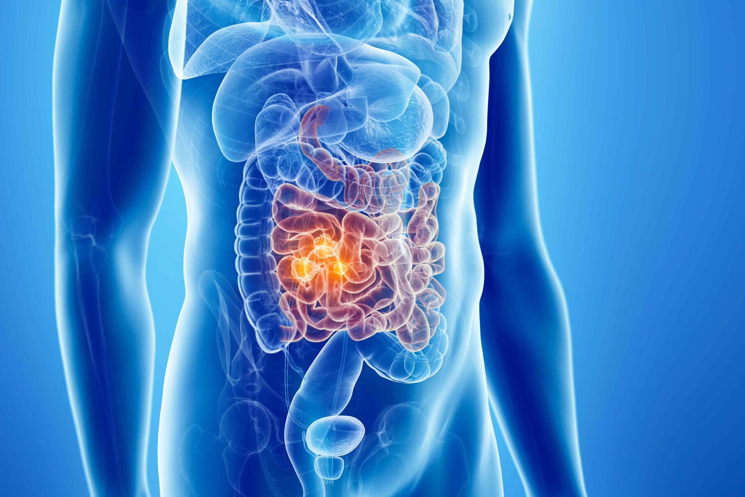 سرطان الامعاء0