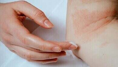 حساسية -صحة