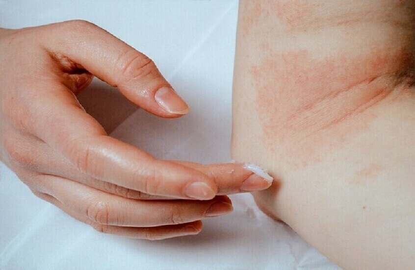 حساسية -صحة