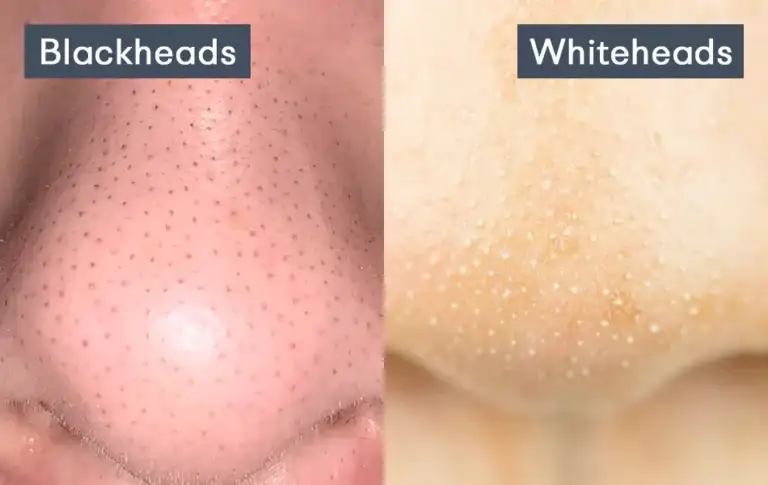 الرؤوس السوداء والبيضاء