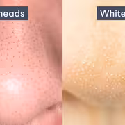 طرق طبيعية للتخلص من الرؤوس السوداء والبيضاء بمكونات متوفرة في المنزل