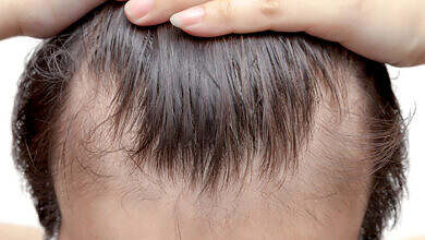 --الصلع-الوراثي-1