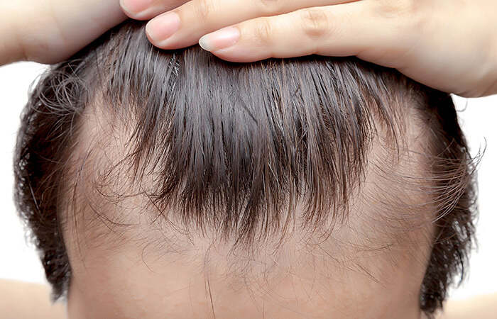 --الصلع-الوراثي-1