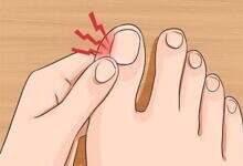 الظفر الغائر – علاج الظفر الغائر – أسباب الظفر الغائر