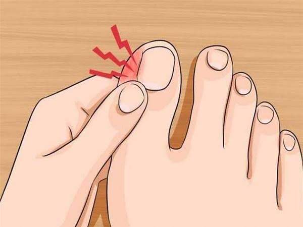 الظفر الغائر – علاج الظفر الغائر – أسباب الظفر الغائر