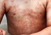 الأكزيما عند الأطفال