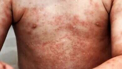 الأكزيما عند الأطفال