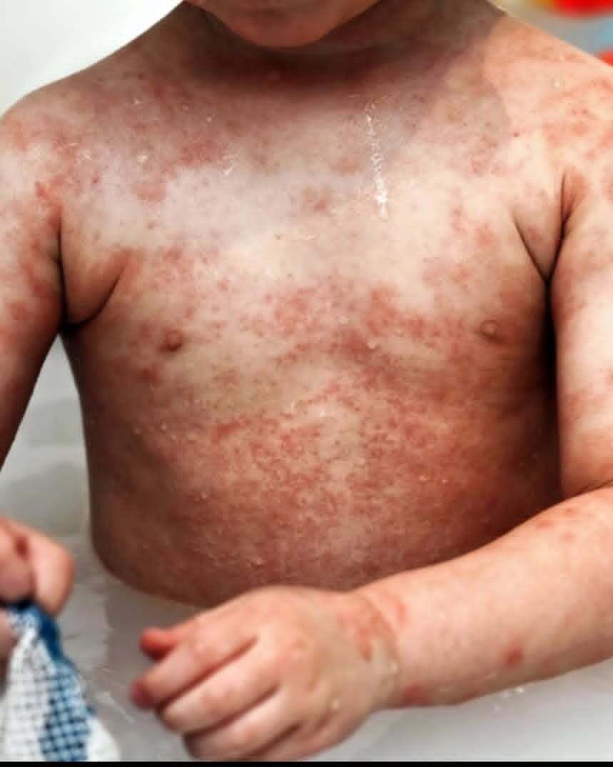 الأكزيما عند الأطفال